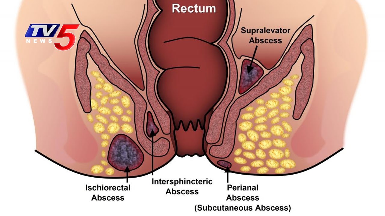 Hernia Surgeon in Nashik , Appendix Surgeon in Nashik