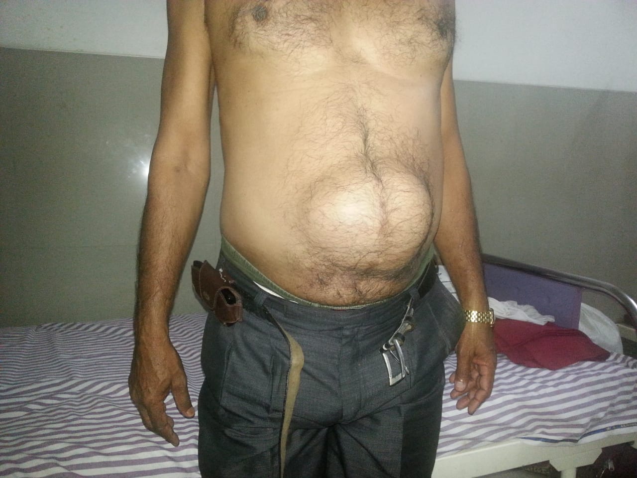 Hernia Surgeon in Nashik