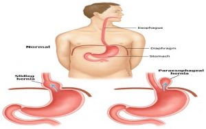 Hernia Surgeon in Nashik , Dr. Harshad Mahatme | Hernia