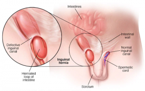 Hernia Surgeon in Nashik , Dr. Harshad Mahatme | Hernia