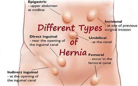 Hernia Surgeon in Nashik , Dr. Harshad Mahatme | Hernia