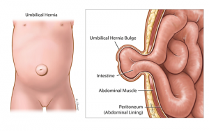 Hernia Surgeon in Nashik , Dr. Harshad Mahatme | Hernia